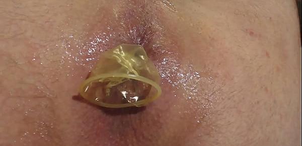 condom buttplug anal prolapse